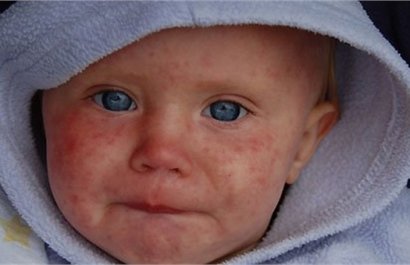 Для предотвращения эпидемии кори в Одессе необходима «сплошная» вакцинация
